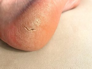 When to Consider Foot Callus Removal